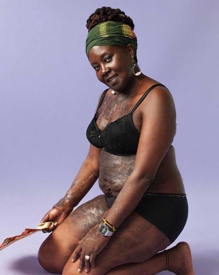 Zdjęcie Sfotografowała ludzi z bliznami oraz poprosiła, aby podzielili się ich historią #3