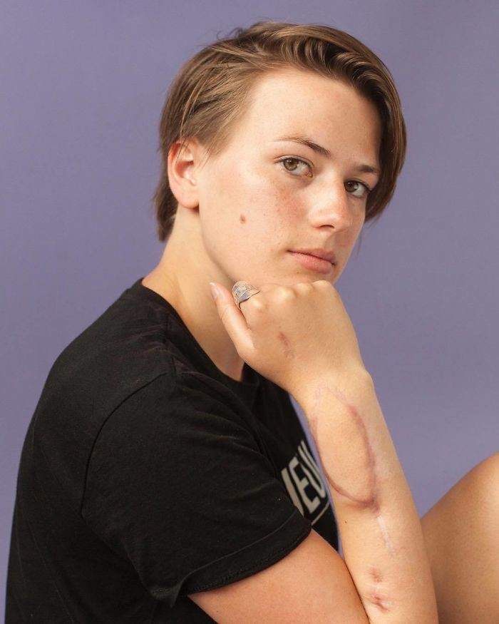 Zdjęcie Sfotografowała ludzi z bliznami oraz poprosiła, aby podzielili się ich historią #4