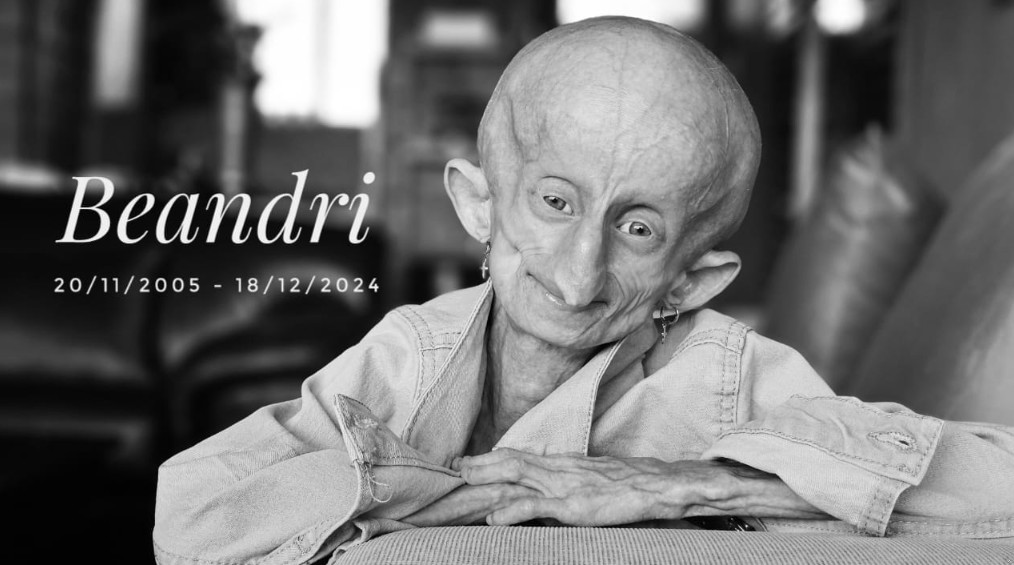 Zdjęcie Nie żyje 19-letnia Tik Tokerka. Jej wiek biologiczny szacowany był na 152 lata! #1